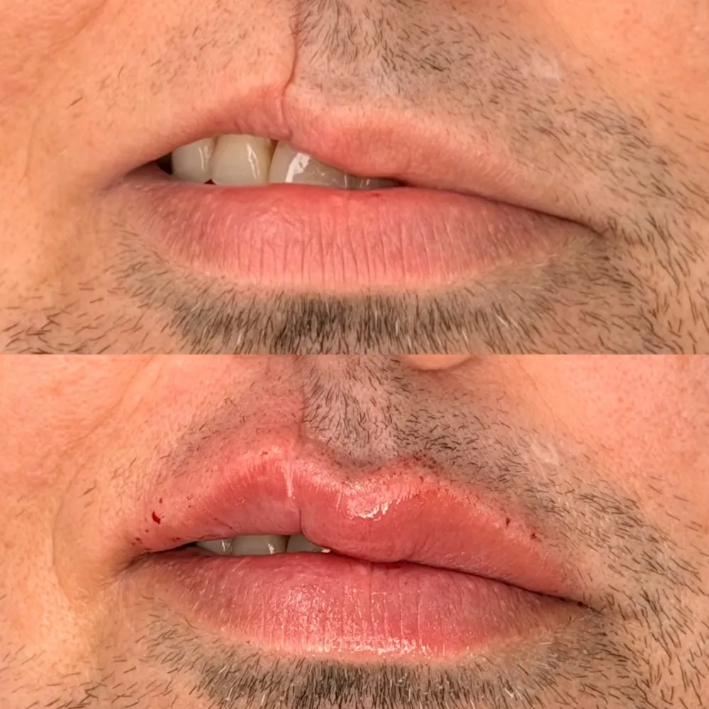 Antes e depois de correção labial