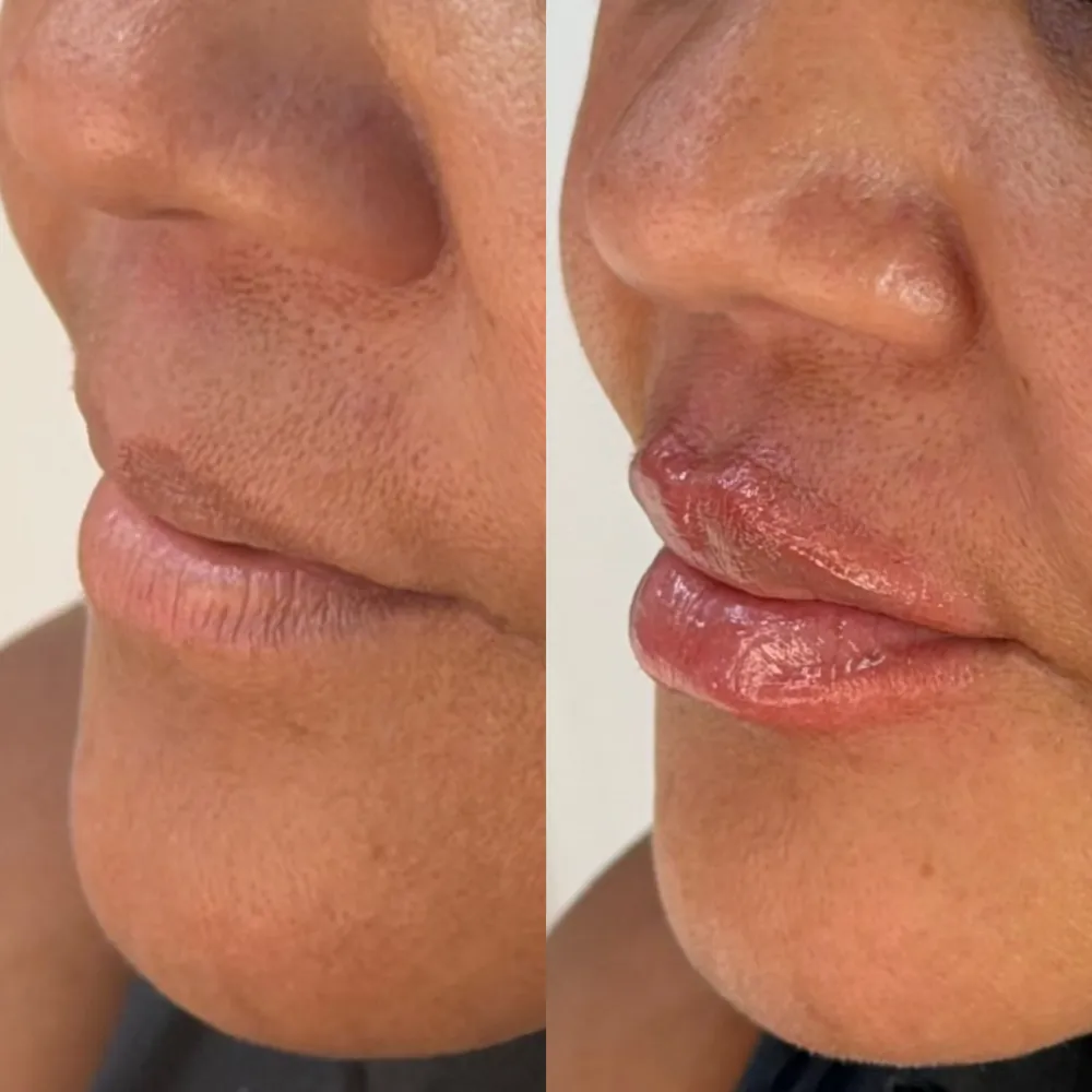 Antes e depois de preenchimento labial
