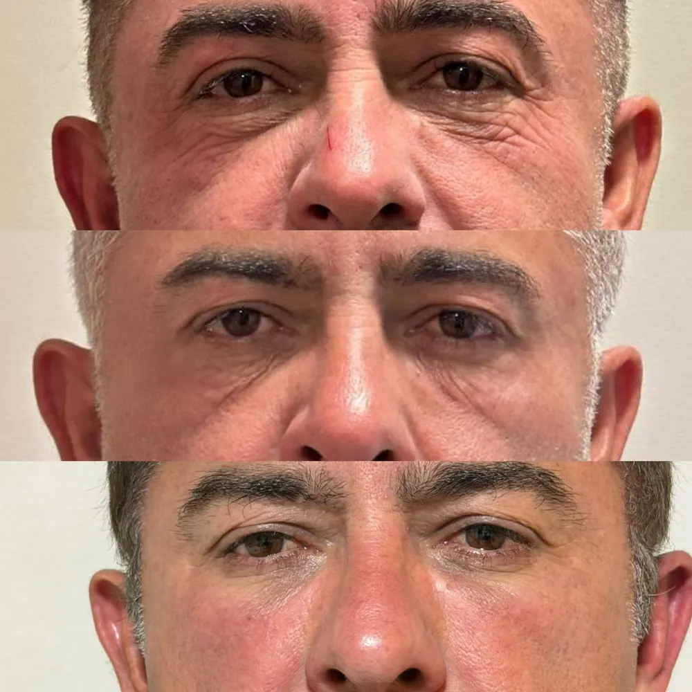 Antes e depois do rejuvenescimento do olhar