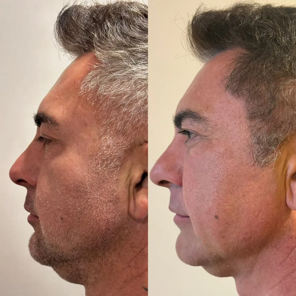Antes e depois de perfil facial