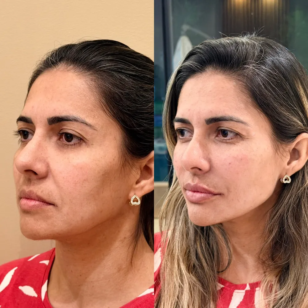Antes e depois de harmonização facial